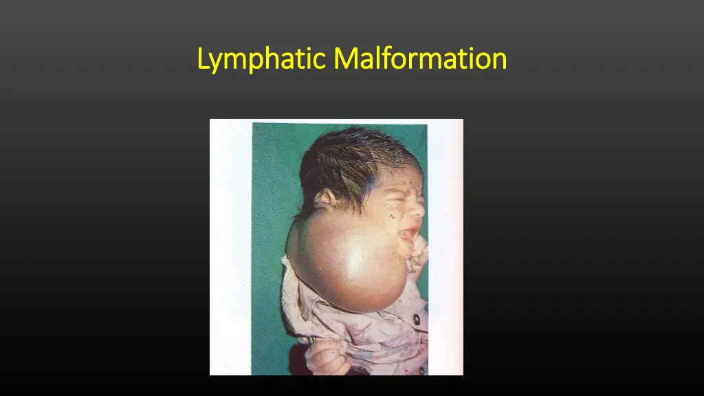 lymphatic malformation lymphatic malformation 1