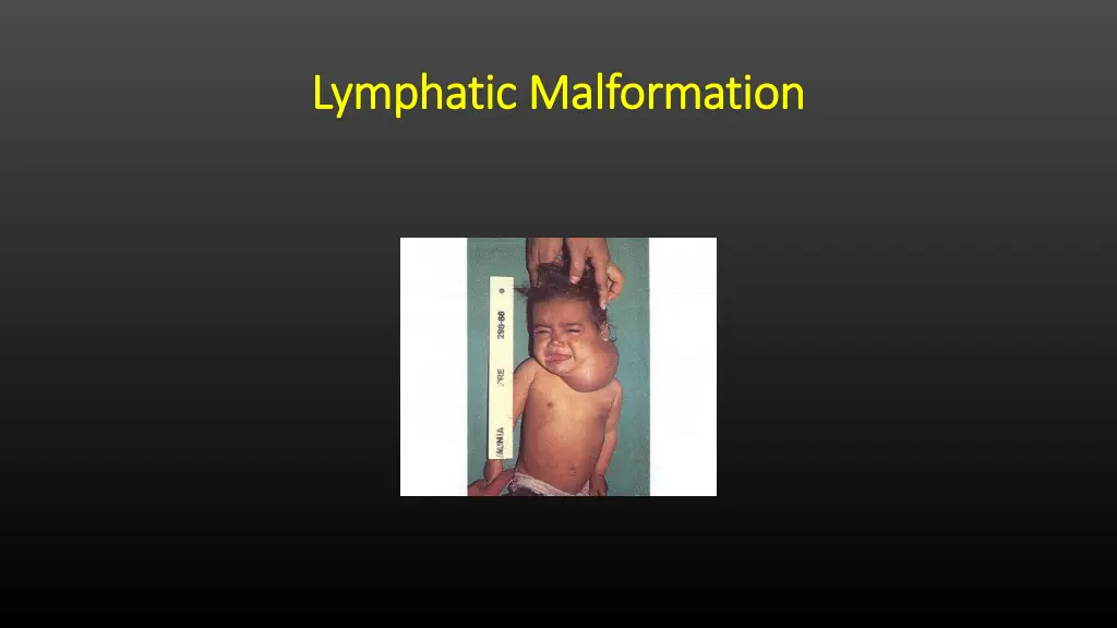 lymphatic malformation lymphatic malformation