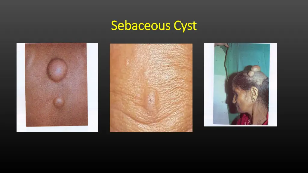 sebaceous cyst sebaceous cyst