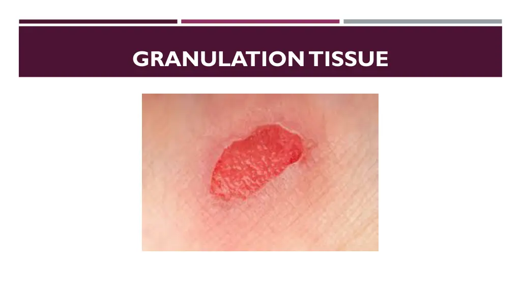 granulation tissue