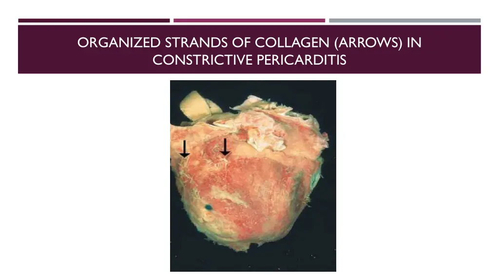 organized strands of collagen arrows