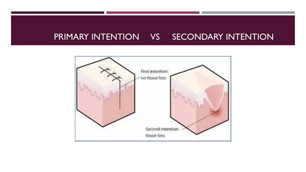 primary intention vs