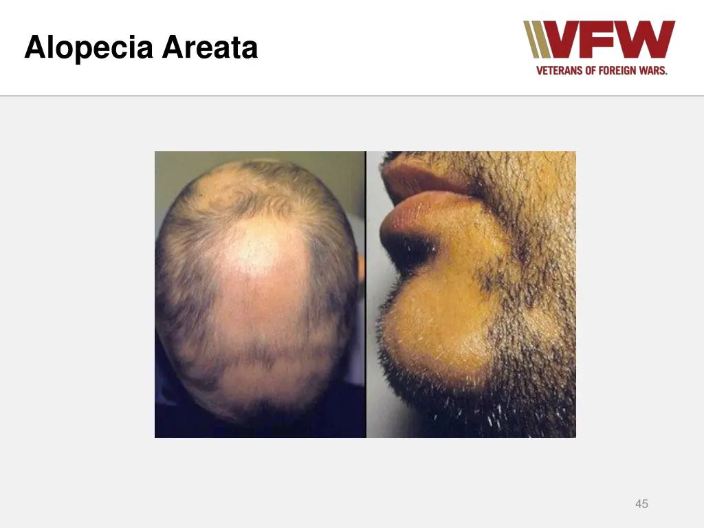 alopecia areata