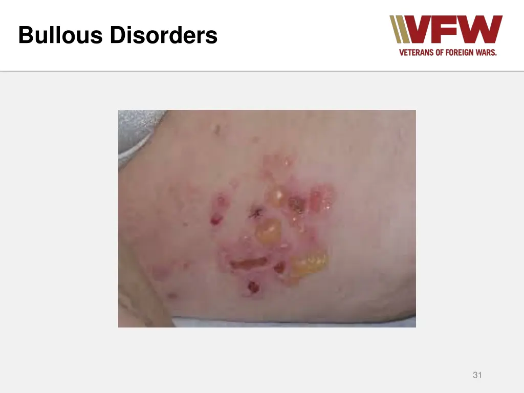 bullous disorders