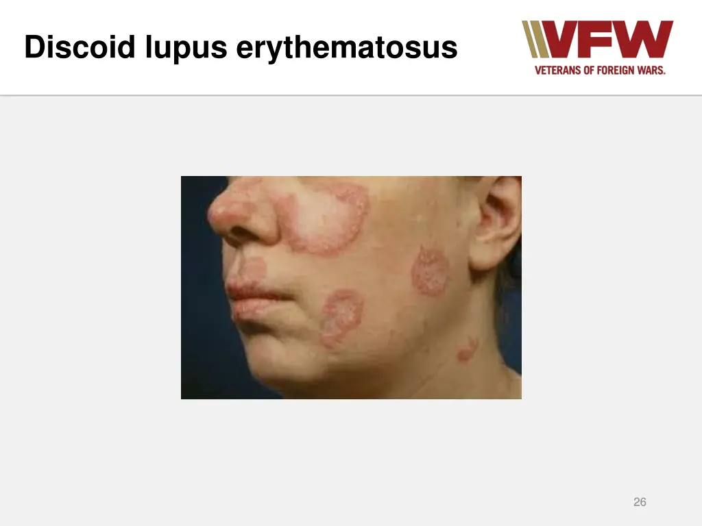 discoid lupus erythematosus