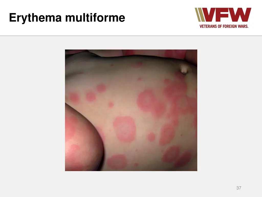 erythema multiforme