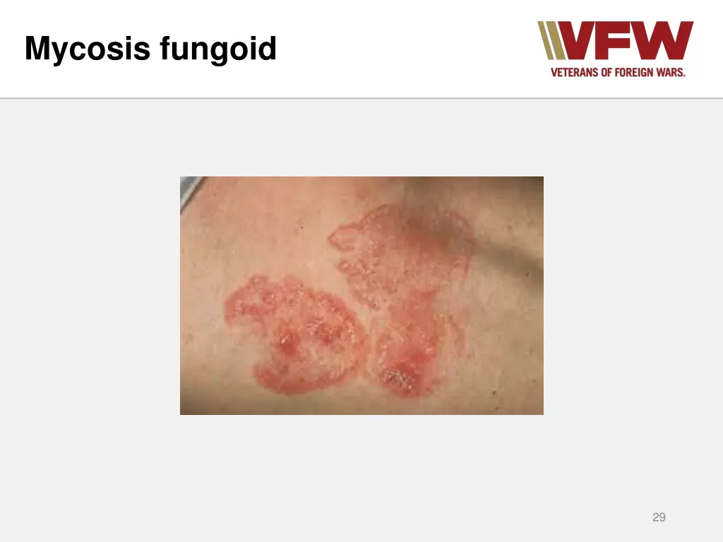 mycosis fungoid