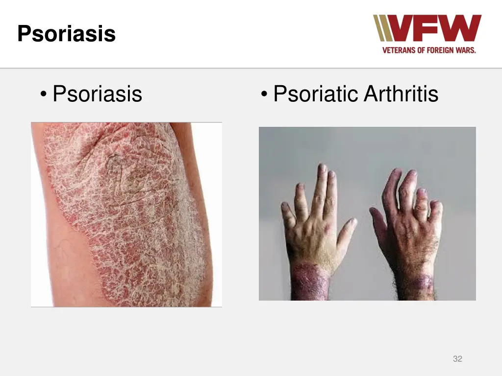 psoriasis