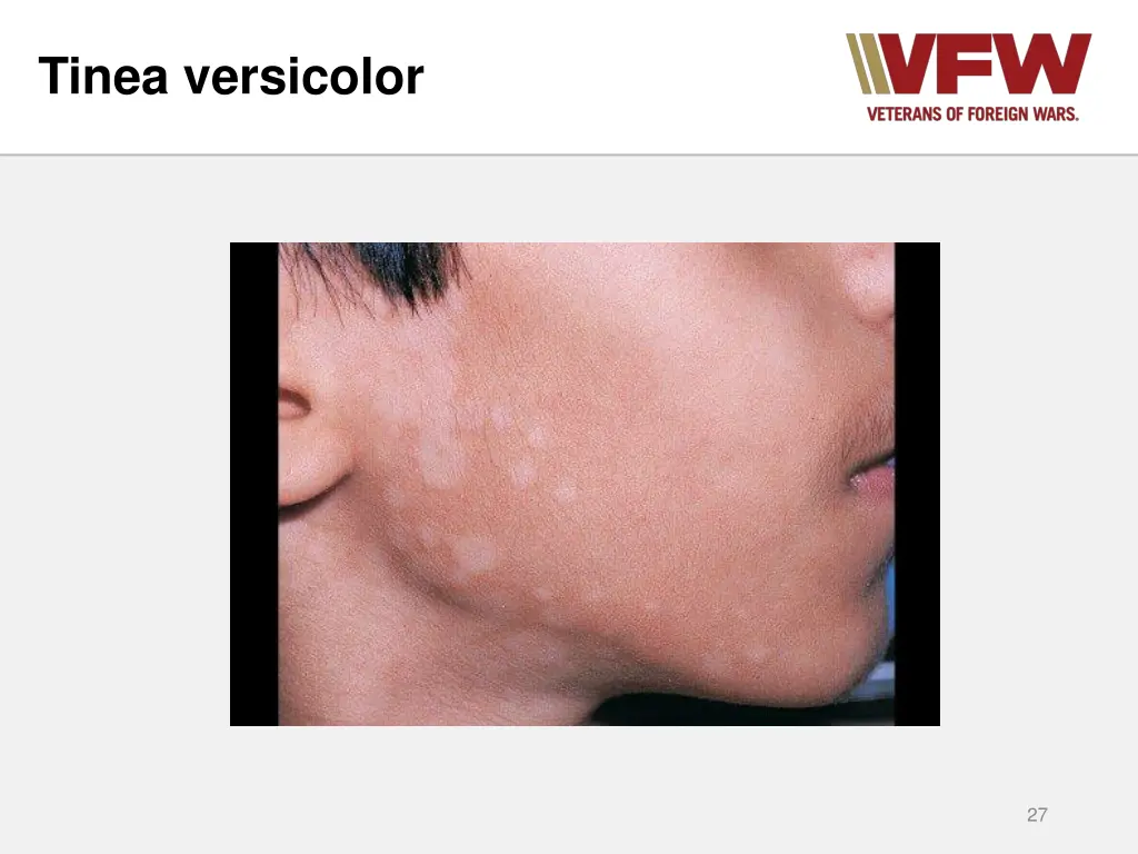 tinea versicolor