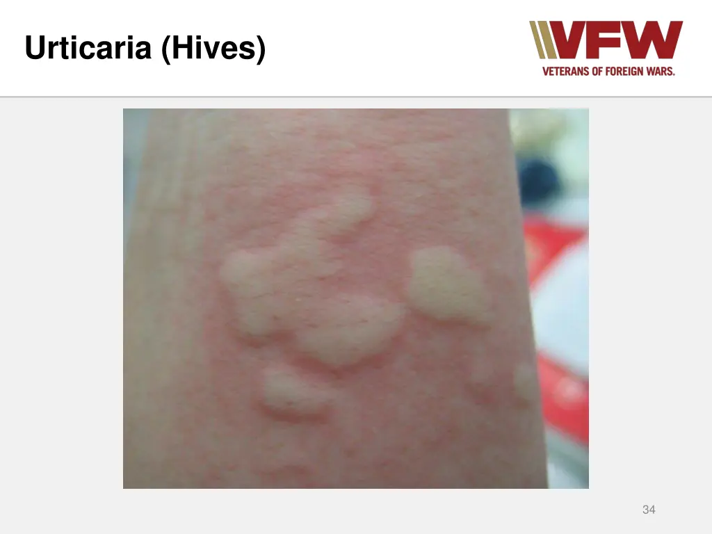 urticaria hives