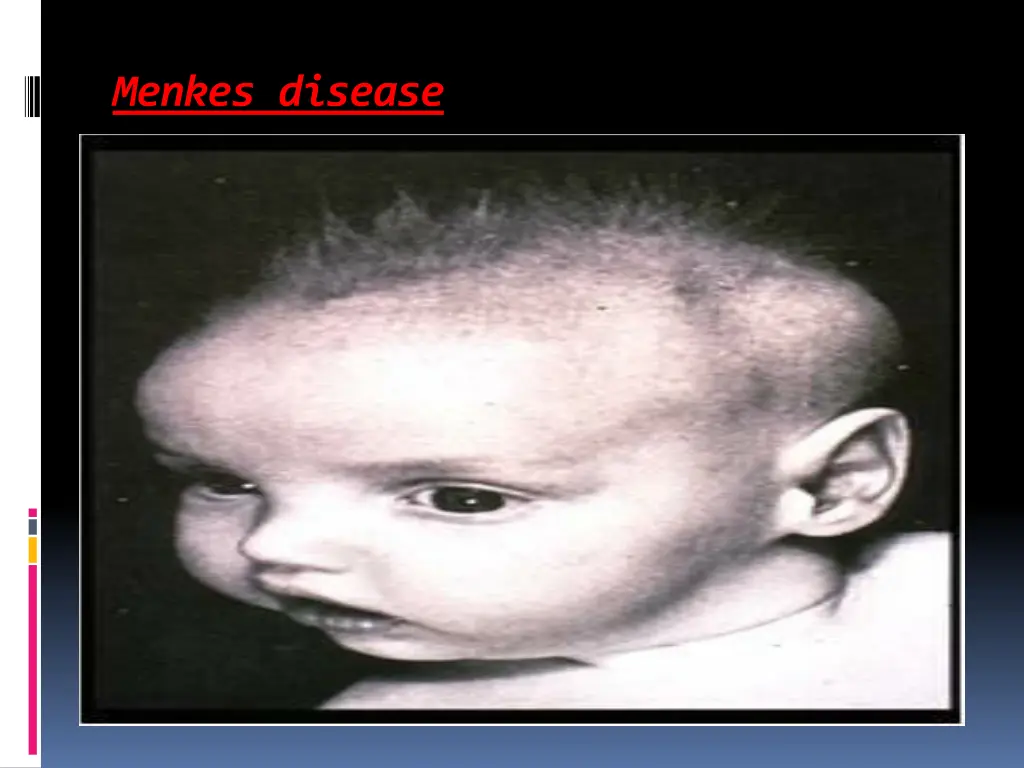 menkes disease 1