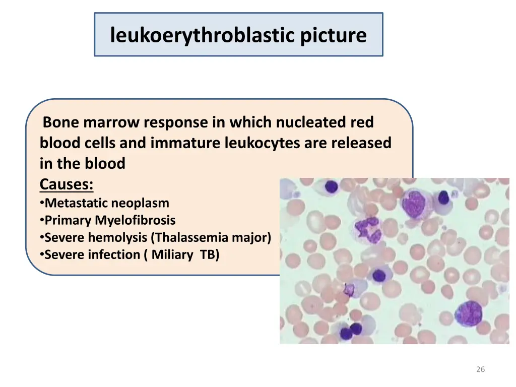 leukoerythroblastic picture