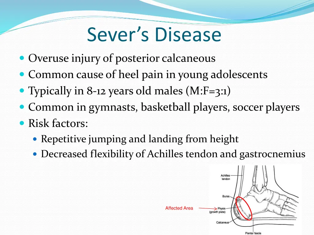 sever s disease