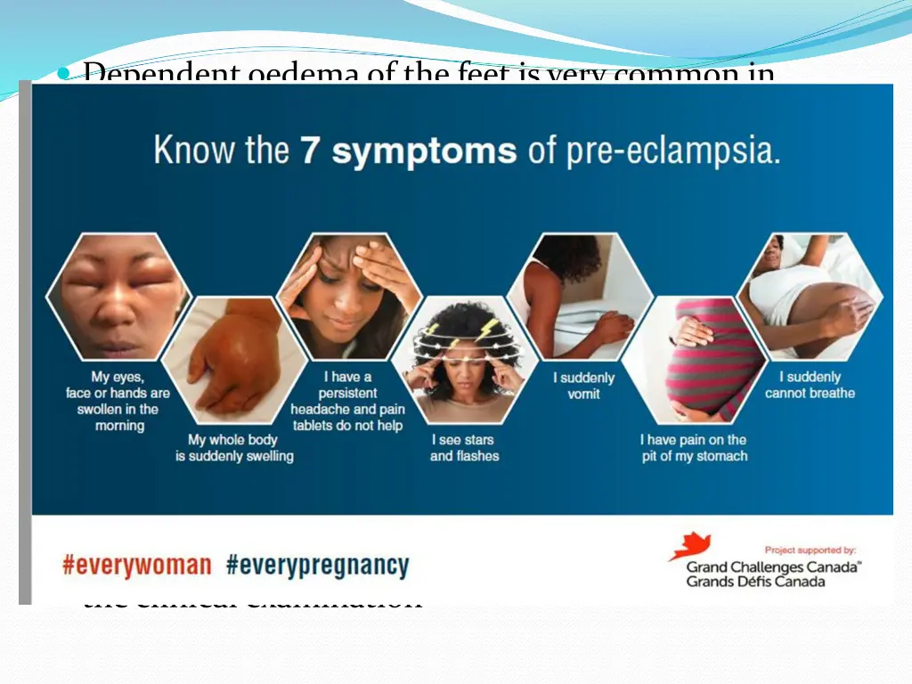 dependent oedema of the feet is very common