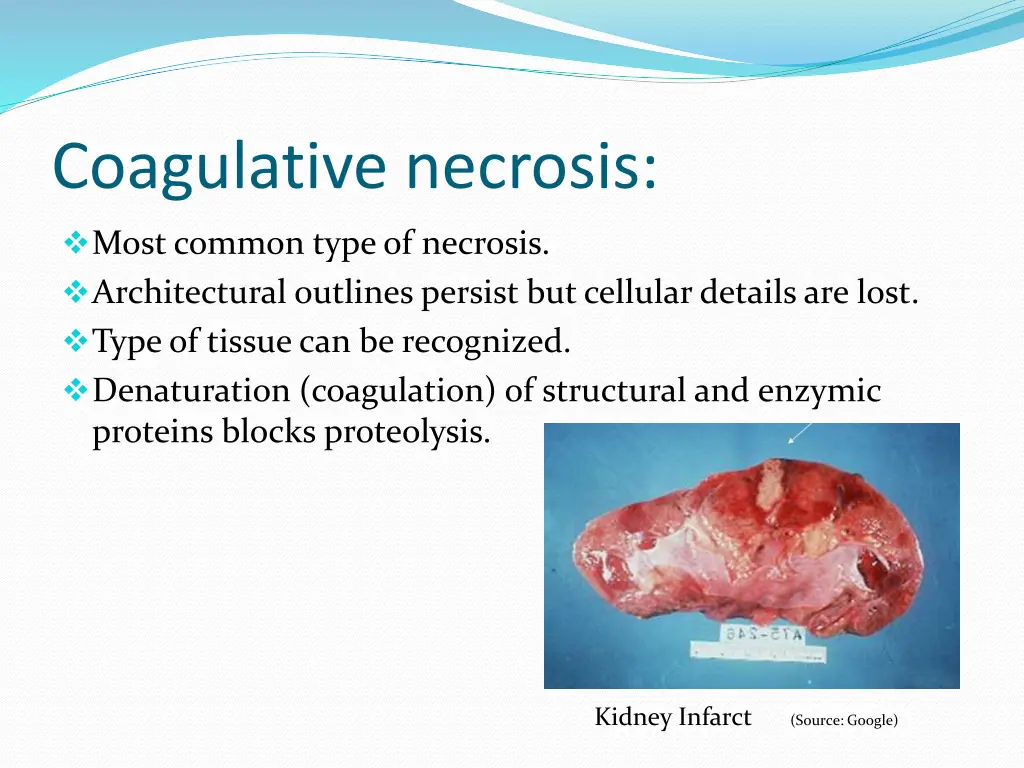 coagulative necrosis