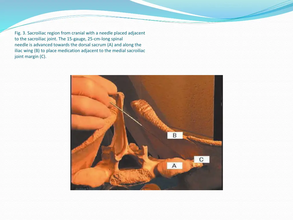 fig 3 sacroiliac region from cranial with