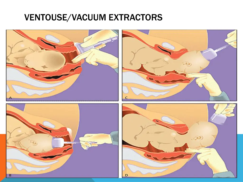 ventouse vacuum extractors