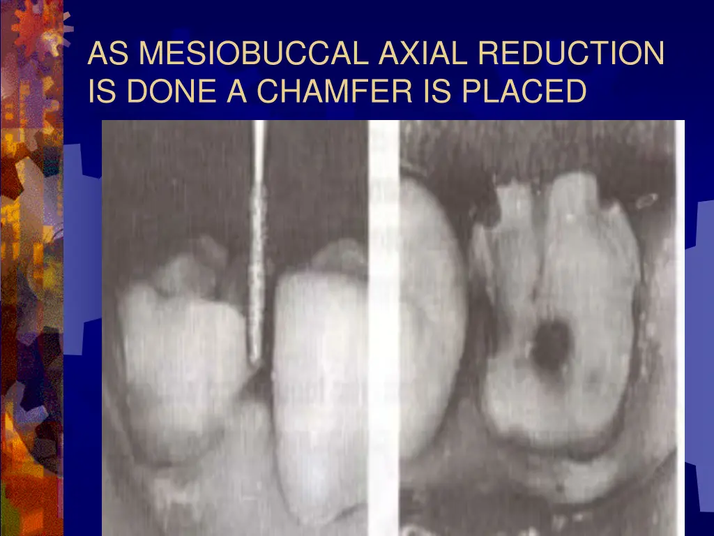 as mesiobuccal axial reduction is done a chamfer