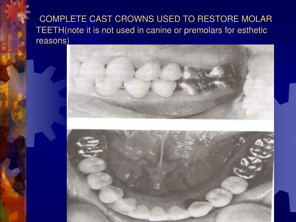 complete cast crowns used to restore molar teeth