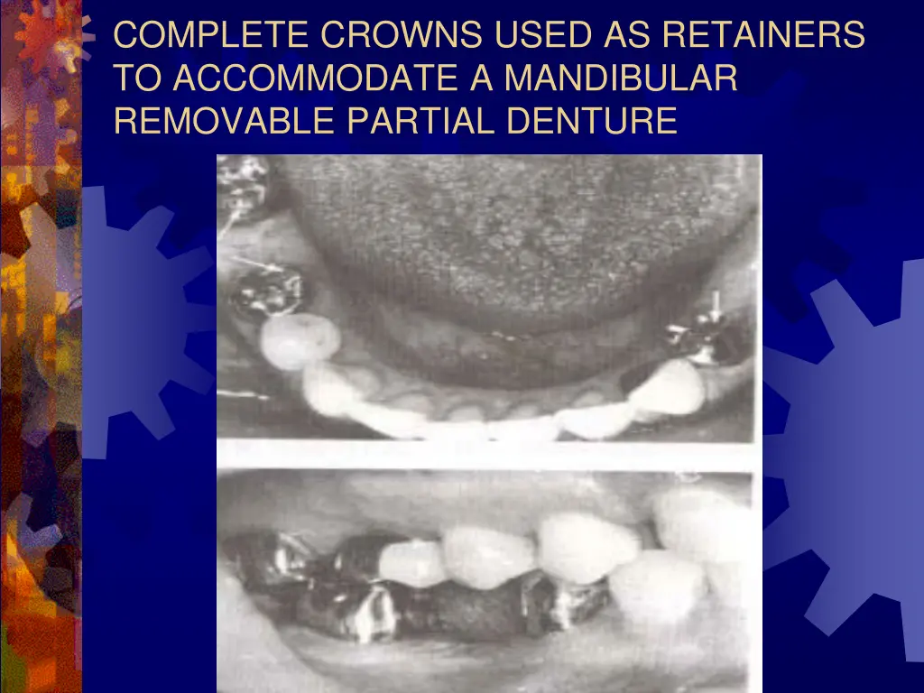 complete crowns used as retainers to accommodate