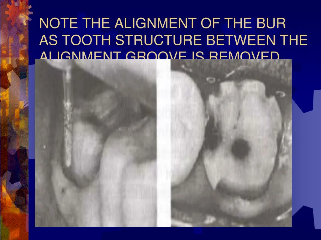 note the alignment of the bur as tooth structure