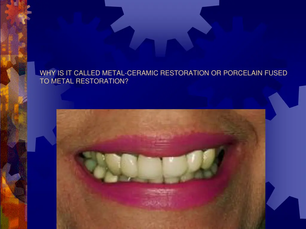 why is it called metal ceramic restoration