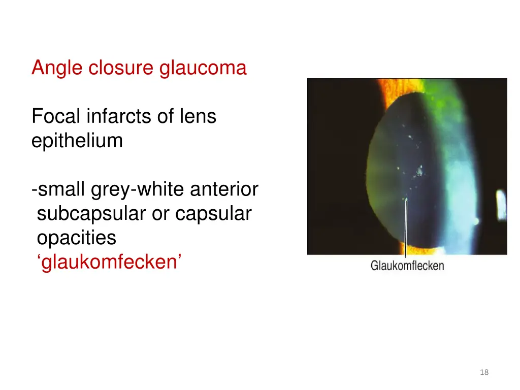 angle closure glaucoma