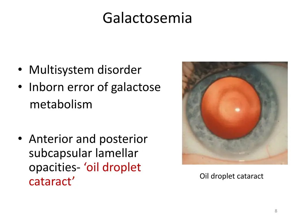 galactosemia