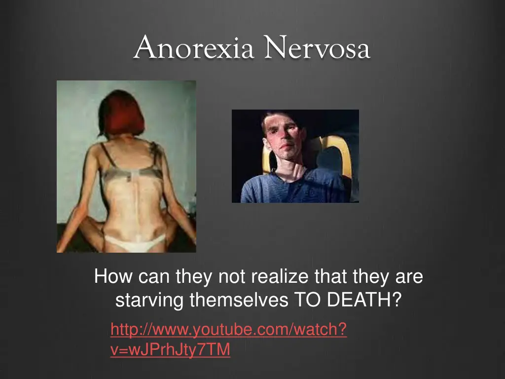 anorexia nervosa 2