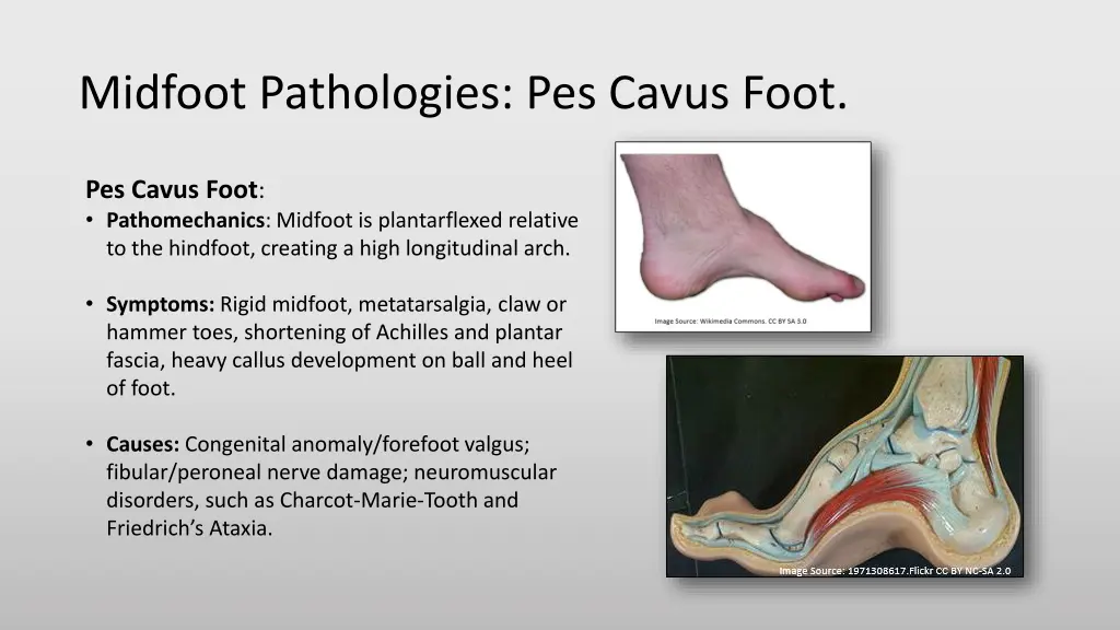 midfoot pathologies pes cavus foot