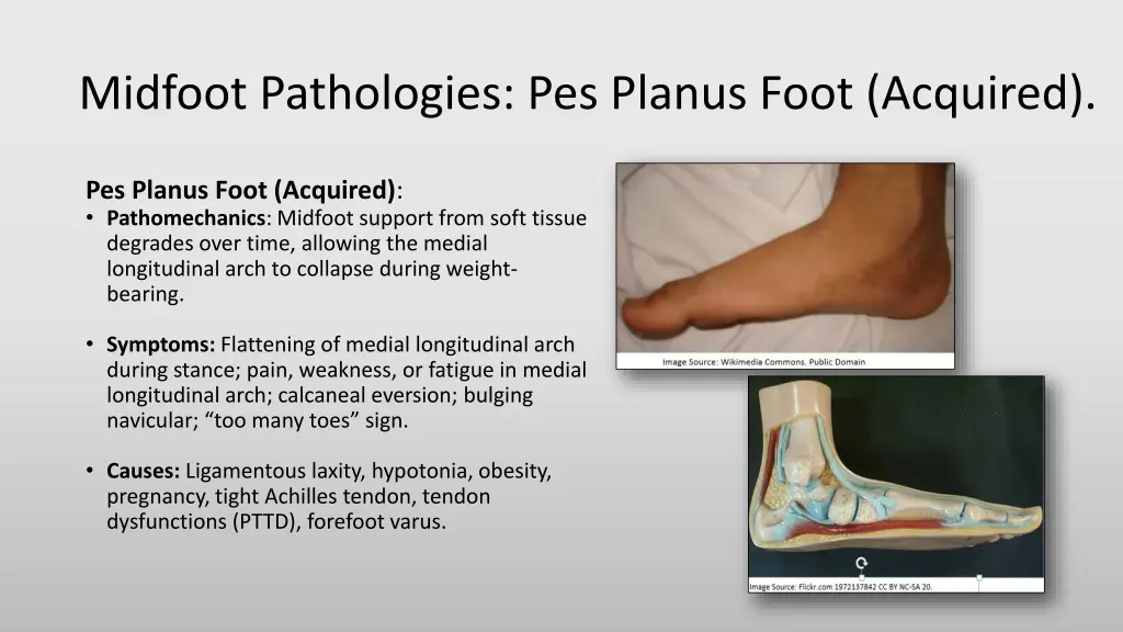 midfoot pathologies pes planus foot acquired