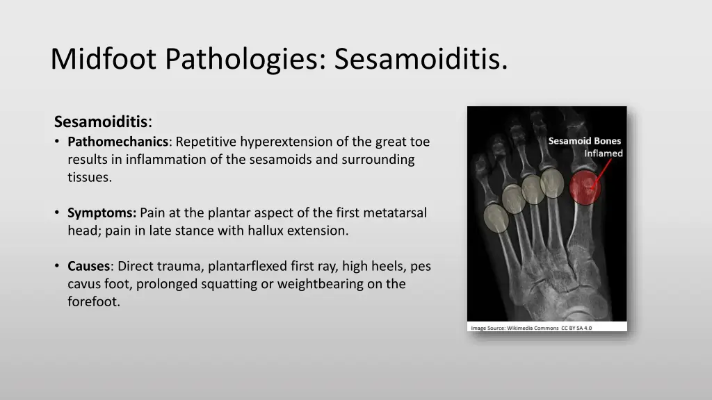 midfoot pathologies sesamoiditis