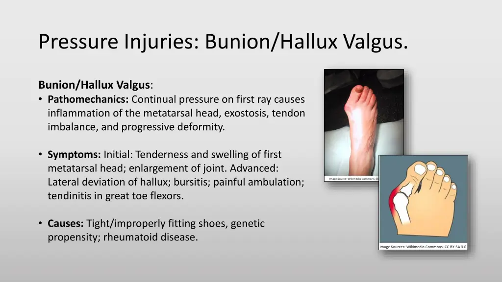 pressure injuries bunion hallux valgus