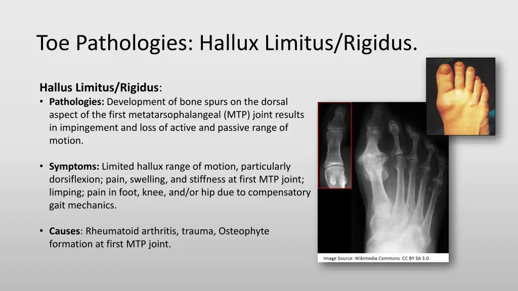 toe pathologies hallux limitus rigidus