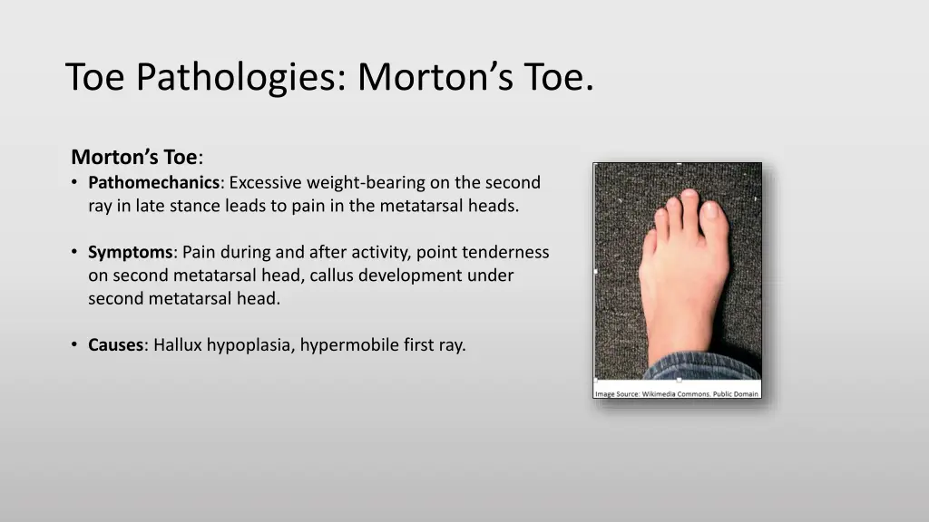 toe pathologies morton s toe