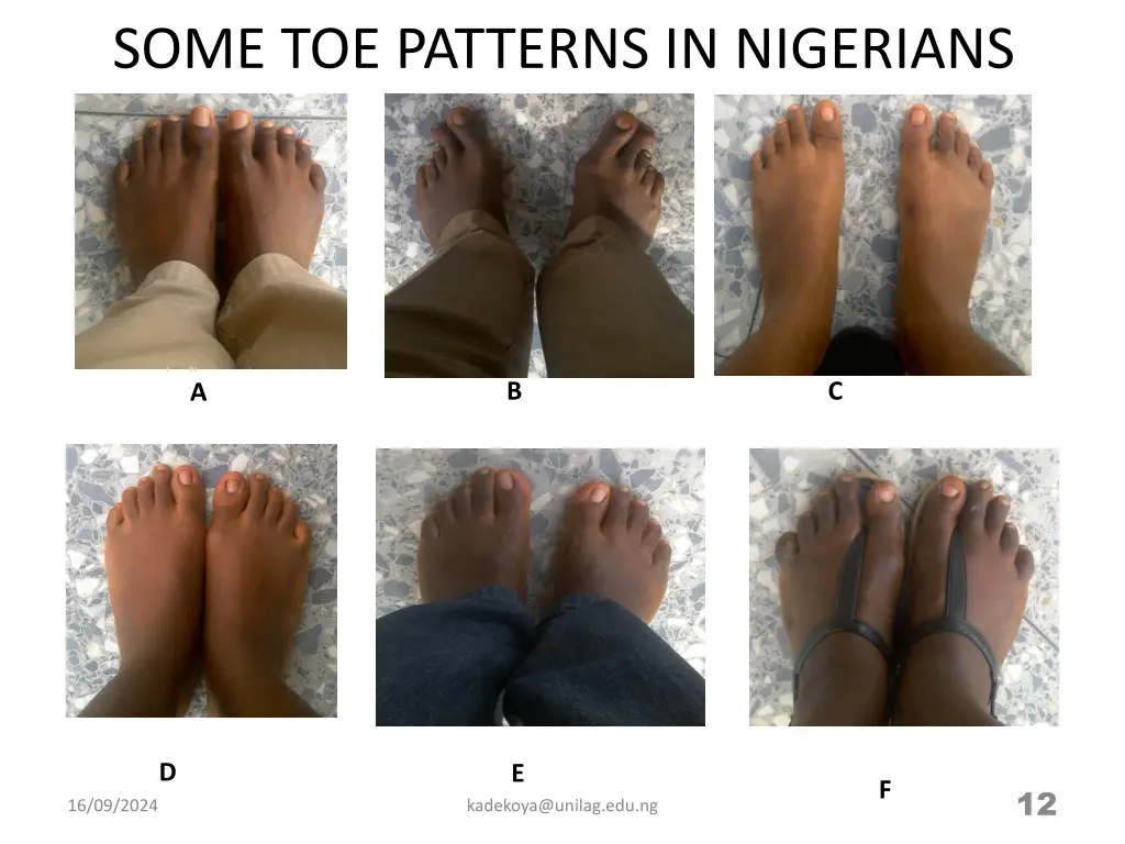 some toe patterns in nigerians