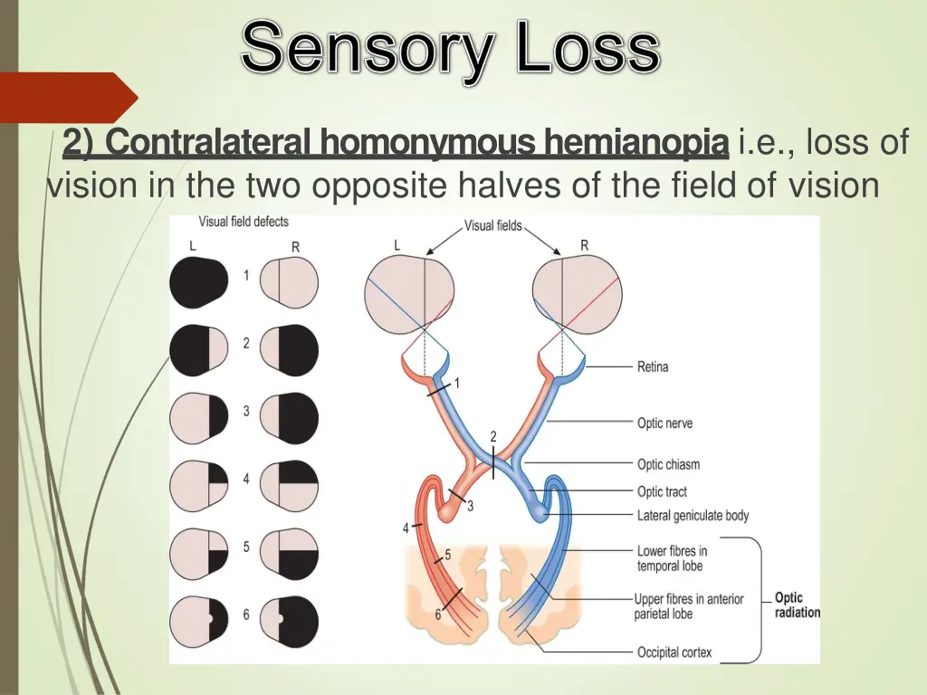 2 contralateral homonymous hemianopia i e loss