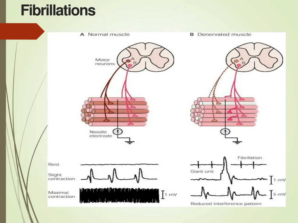 fibrillations