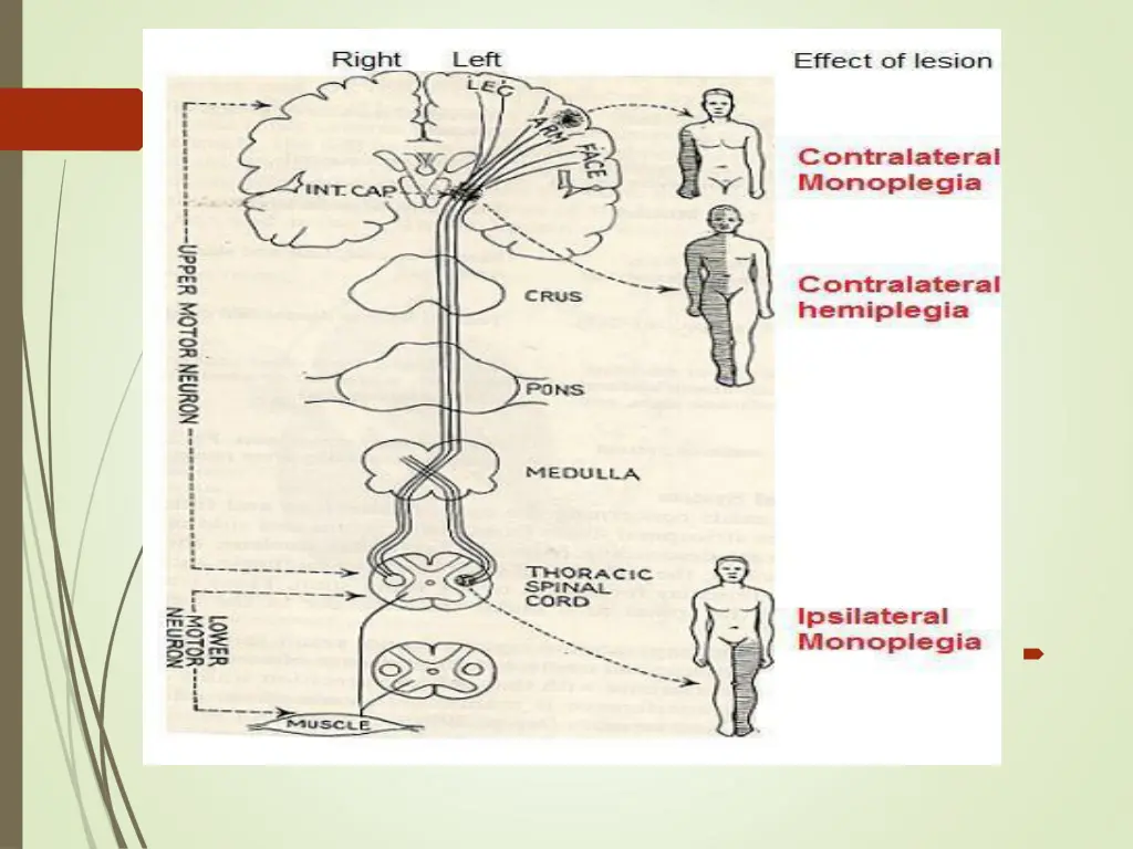 the effect of a lesion in different parts 1