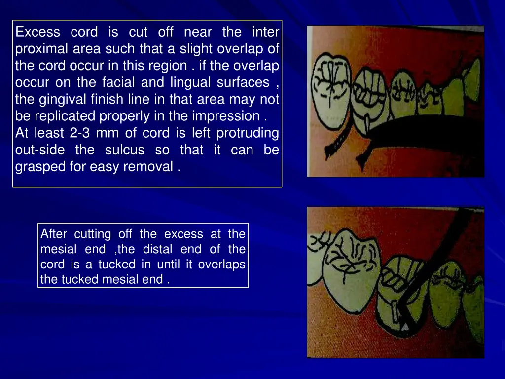 excess cord is cut off near the inter proximal