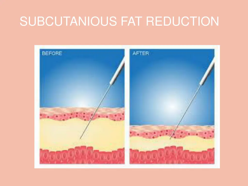 subcutanious fat reduction