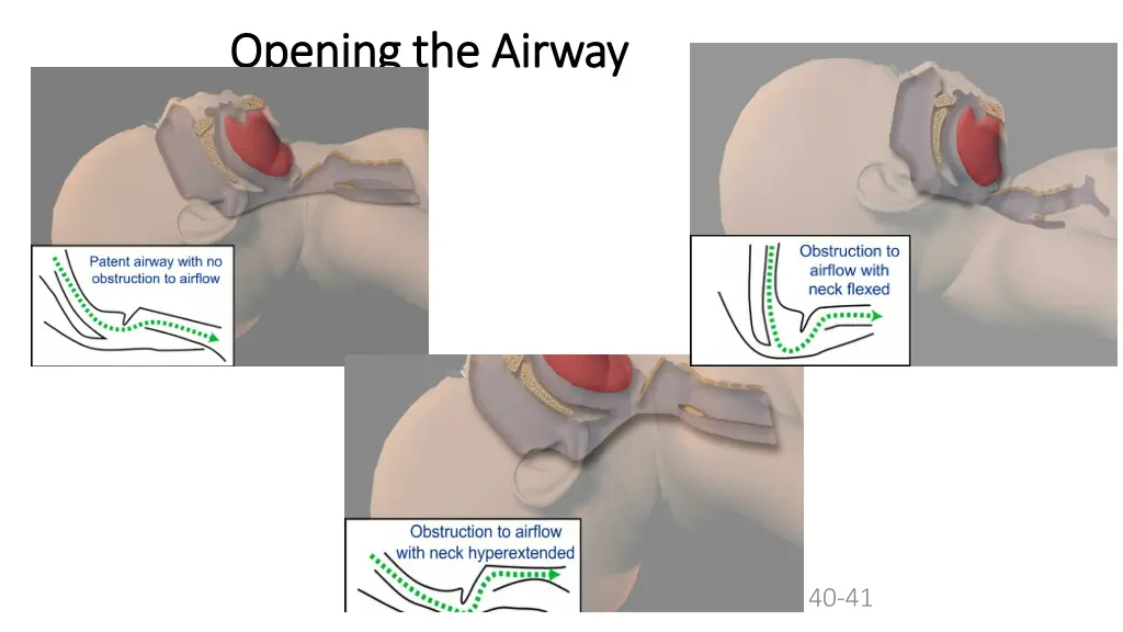 opening the airway opening the airway 1