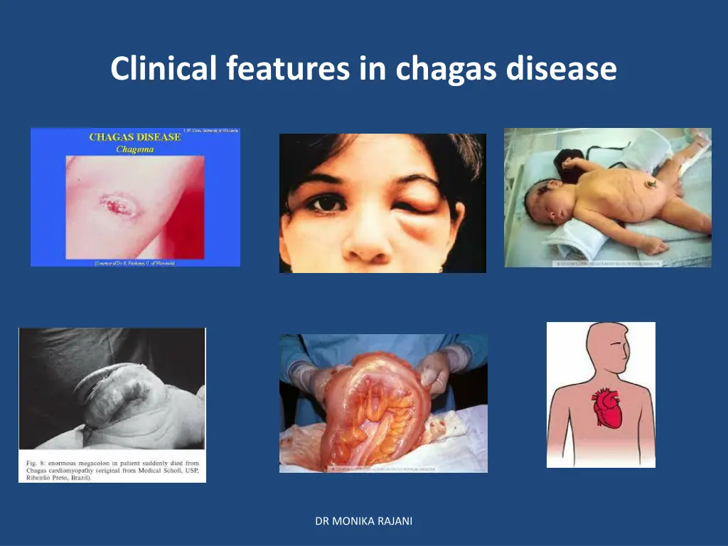 clinical features in chagas disease