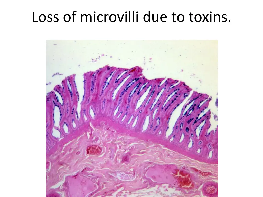 loss of microvilli due to toxins