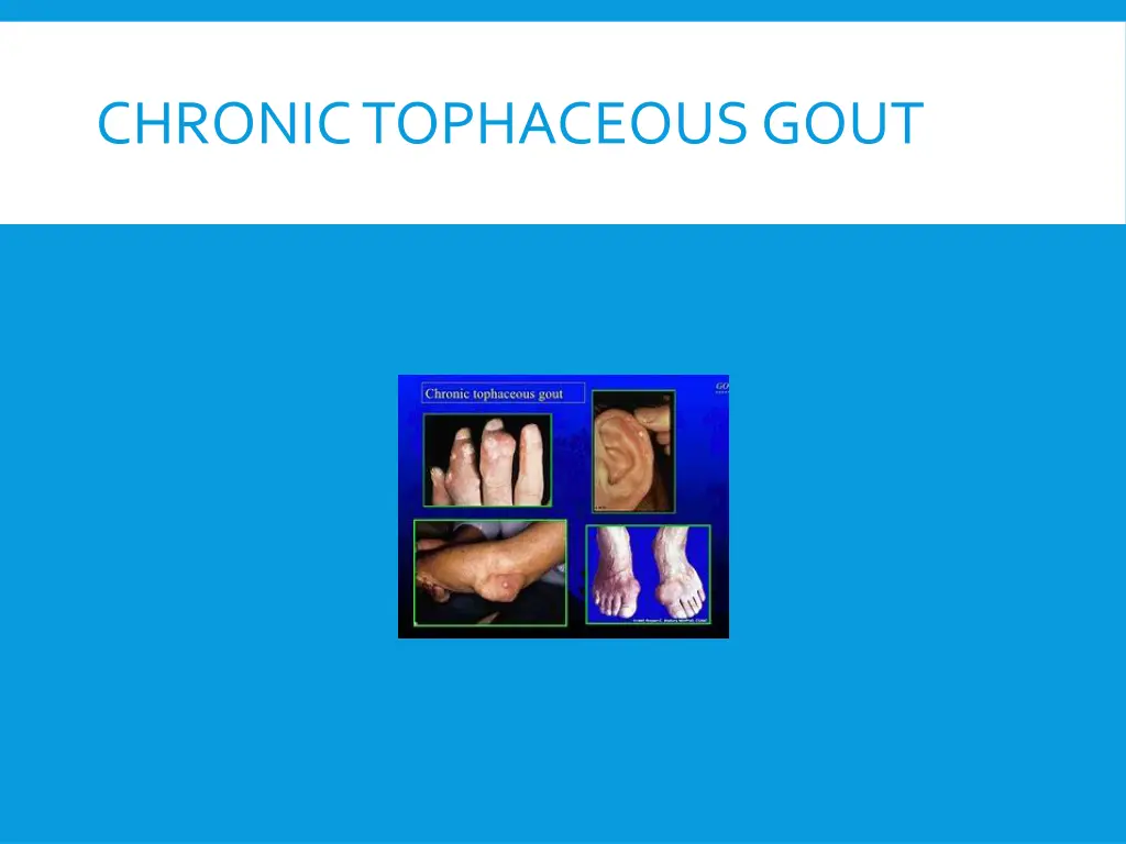 chronic tophaceous gout 1