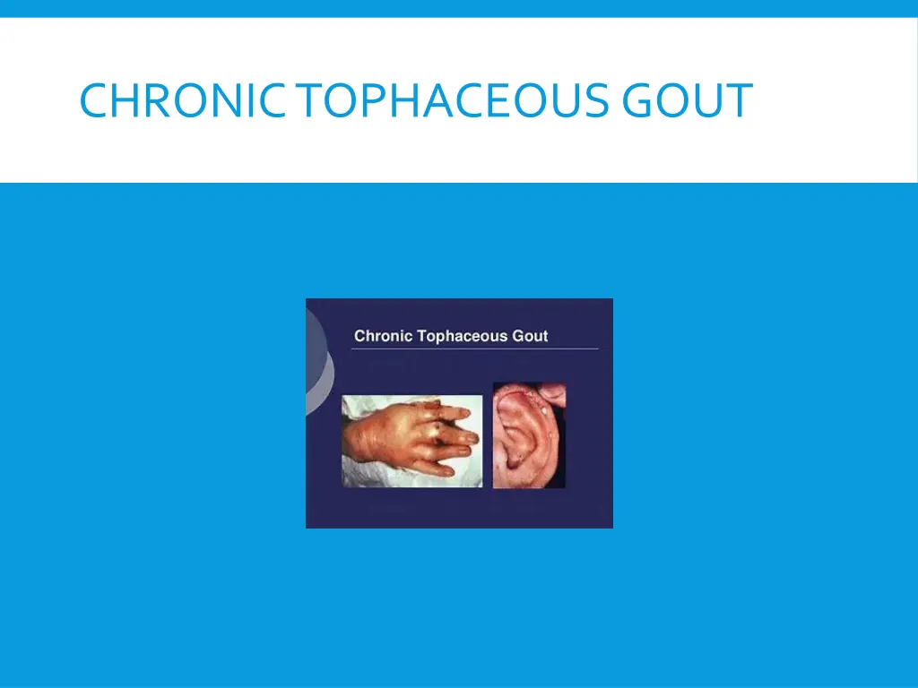 chronic tophaceous gout