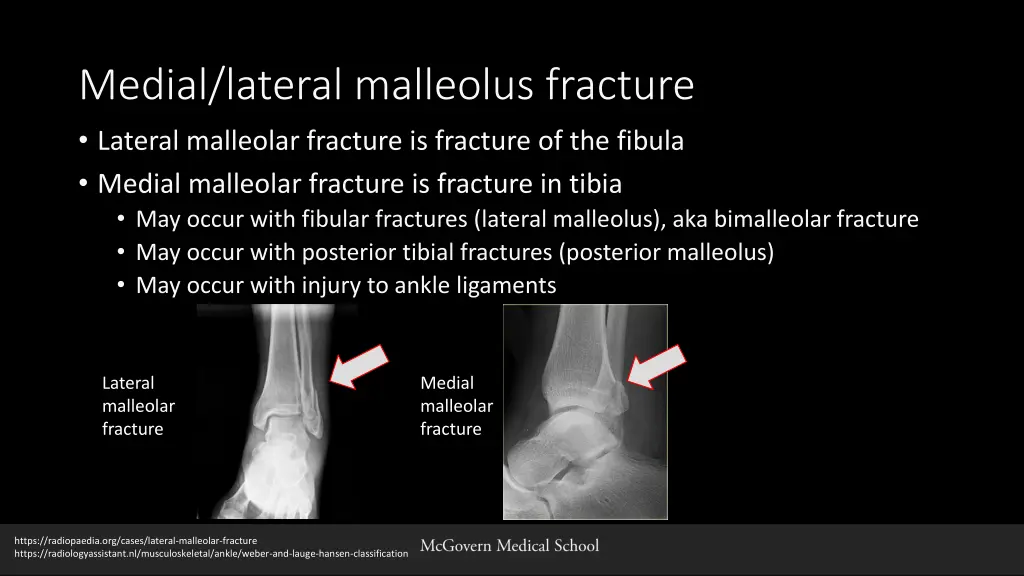 medial lateral malleolus fracture lateral