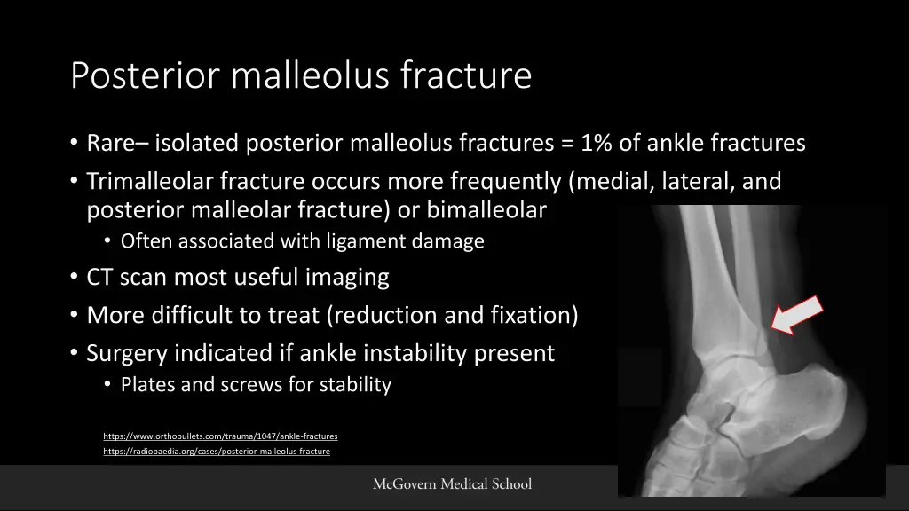 posterior malleolus fracture