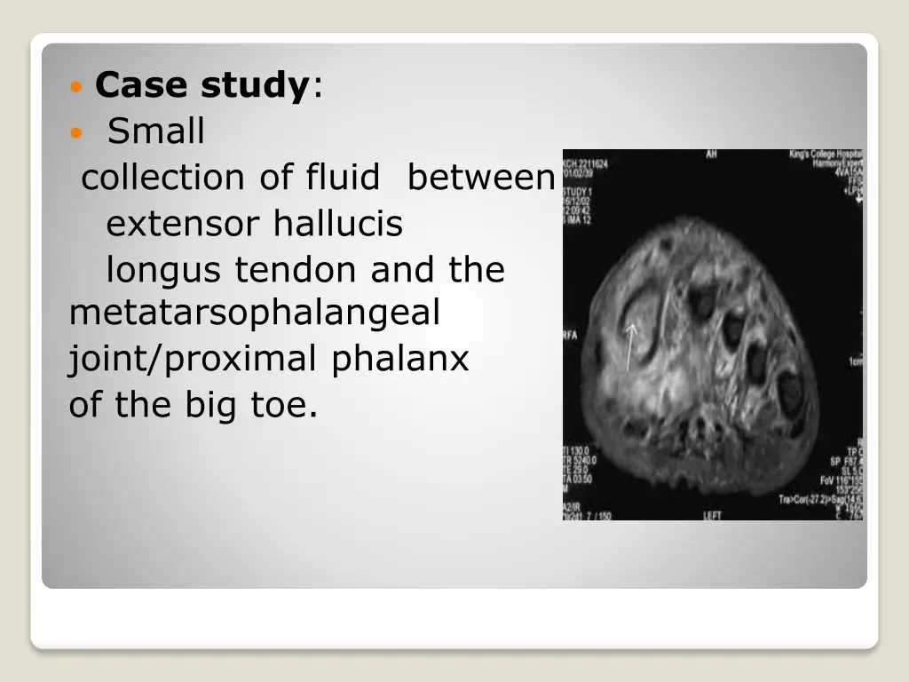 case study small collection of fluid between