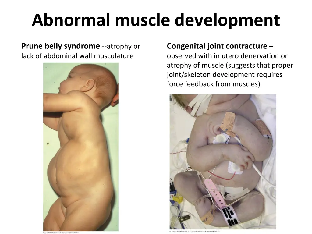 abnormal muscle development 1